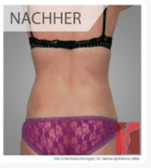 Vorher-Nachher Foto der Ultraschall Liposuktion  durchgeführt von - Dr. Sabine Apfolterer MBA